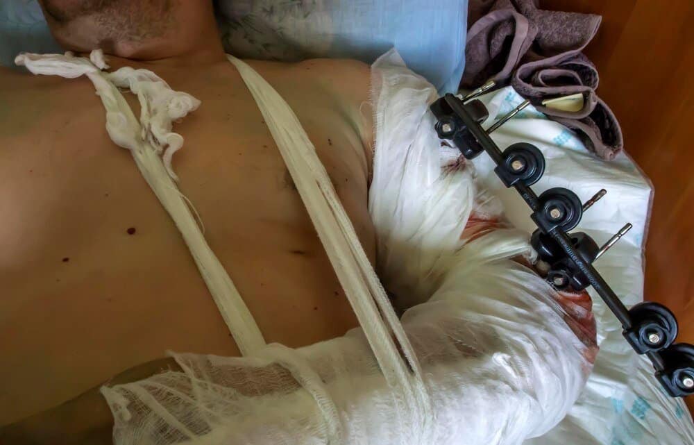 Rekonwalescencja po operacji żylaków: jak dbać o nogi i unikać powikłań